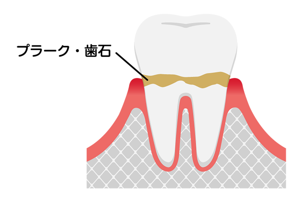 初期段階：歯肉炎